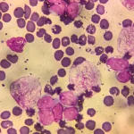 1 in 8 cancer cases worldwide linked to infections, study finds