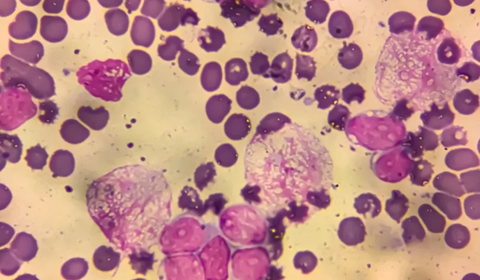 1 in 8 cancer cases worldwide linked to infections, study finds