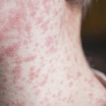 Wood County Health Department confirms one case of measles; several possible exposure sites in Bowling Green