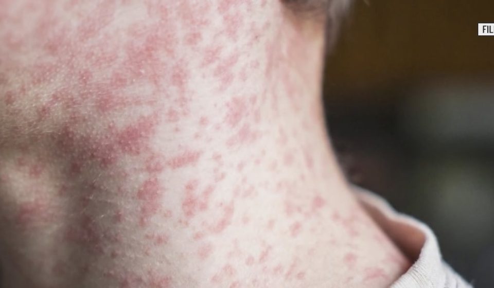 Wood County Health Department confirms one case of measles; several possible exposure sites in Bowling Green