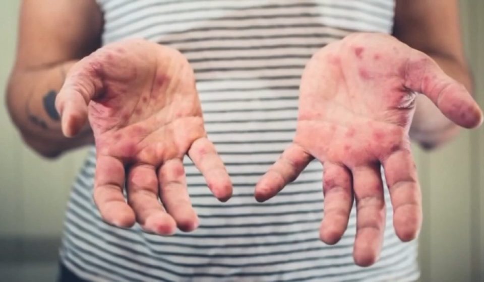 2 Chicago hotels on list of measles exposure locations in Illinois – NBC Chicago