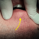 About a case of pleomorphic adenoma of the lower lip: a rare location and a diagnostic pitfall - cureus.com