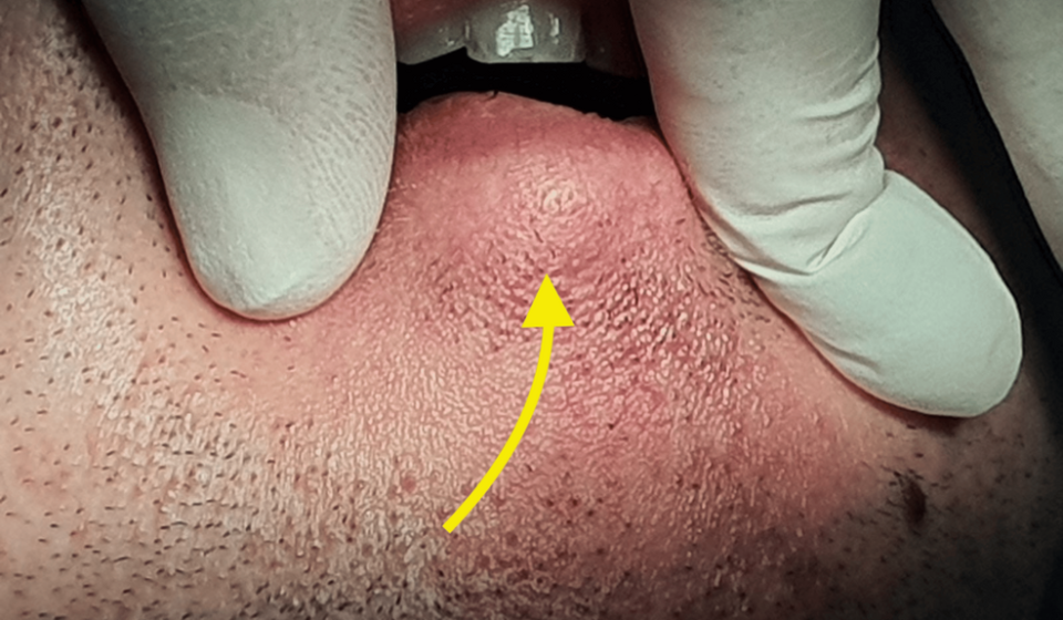 About a case of pleomorphic adenoma of the lower lip: a rare location and a diagnostic pitfall - cureus.com