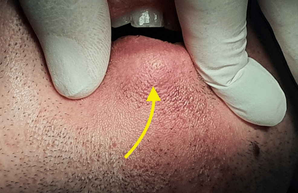 About a case of pleomorphic adenoma of the lower lip: a rare location and a diagnostic pitfall - cureus.com