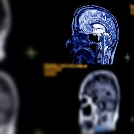 Menopausal brain fog and dementia: how women can make a difference