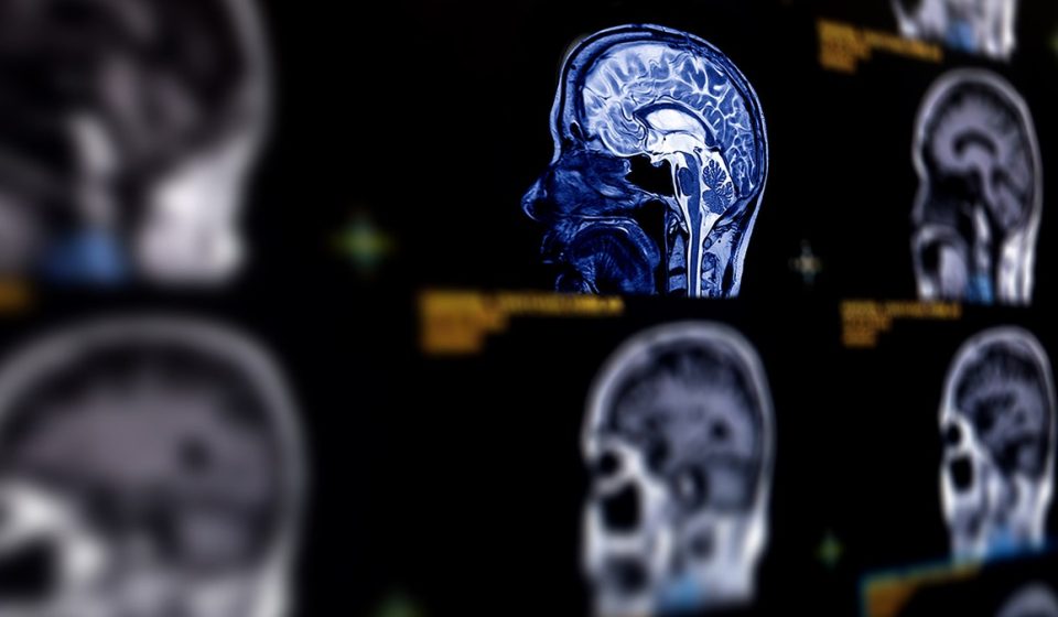 Menopausal brain fog and dementia: how women can make a difference