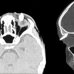 Teenager is 'first' patient to have tooth growing in weird place