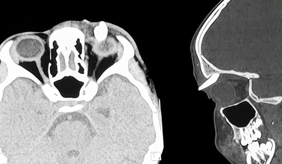 Teenager is 'first' patient to have tooth growing in weird place