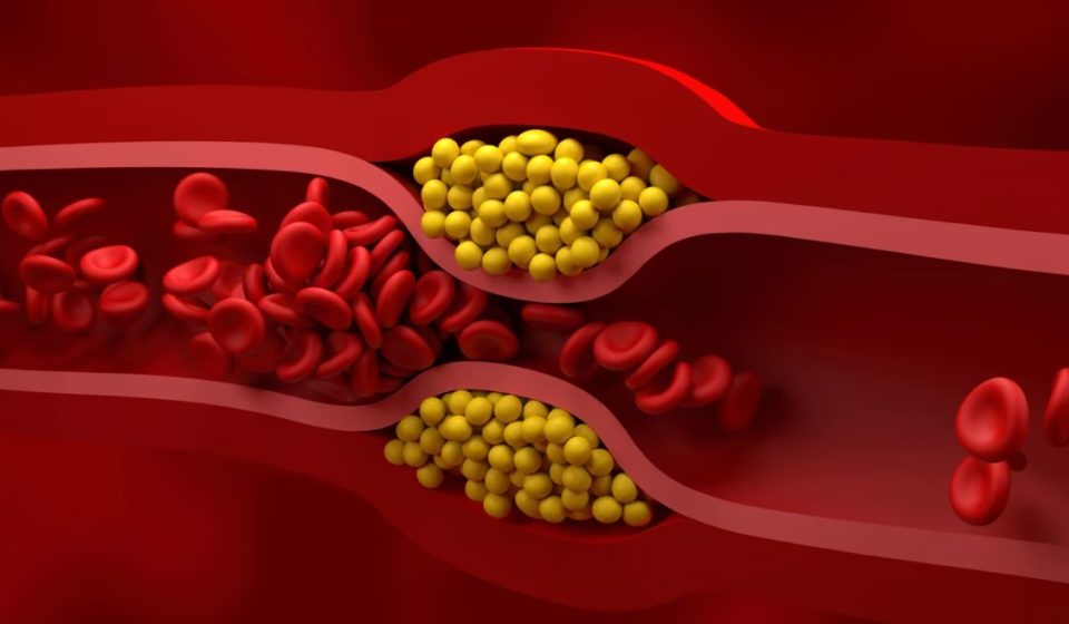 “52.5% less bad cholesterol”: a treatment that doctors did not see coming