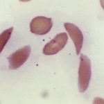 Sickle cell gene therapies offer new hope, but access is difficult