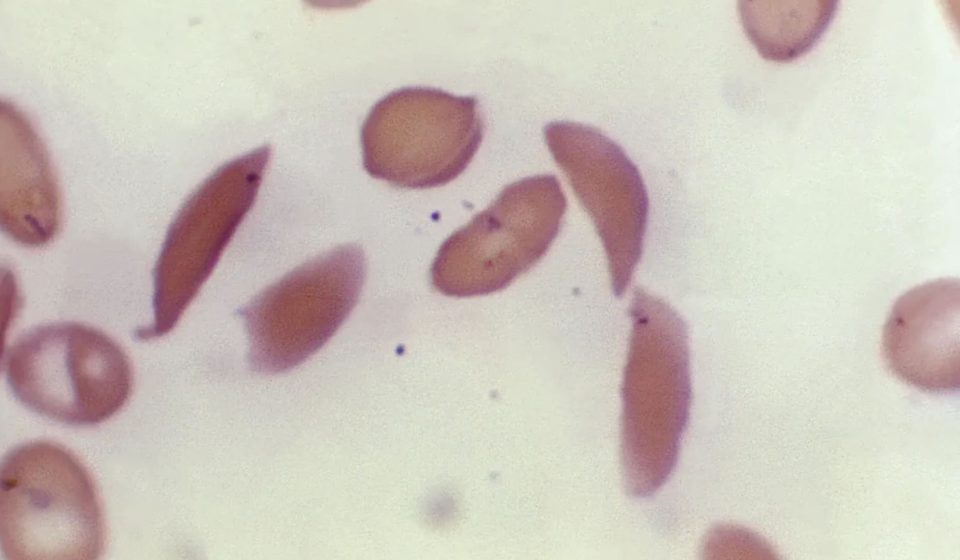 Sickle cell gene therapies offer new hope, but access is difficult