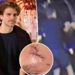 Pretty Little Liars Star Keegan Allen Reveals Stitches Following LA Armed Robbery