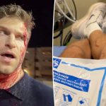 Keegan Allen Posts Painful Photo After Being Brutally Robbed In Los Angeles
