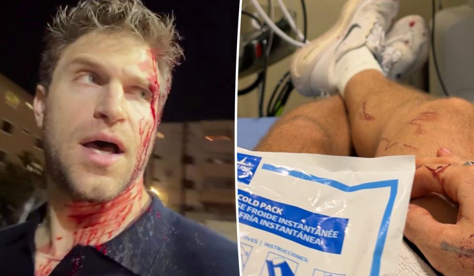 Keegan Allen Posts Painful Photo After Being Brutally Robbed In Los Angeles