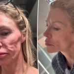 Brandi Glanville to get 'facelifted' for 'power wash' under skin