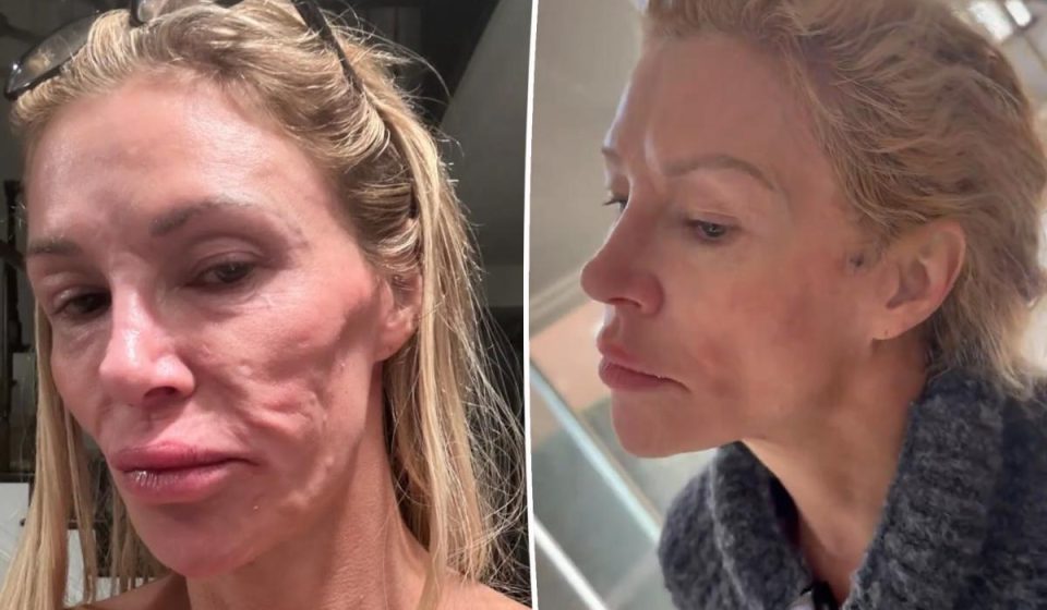 Brandi Glanville to get 'facelifted' for 'power wash' under skin