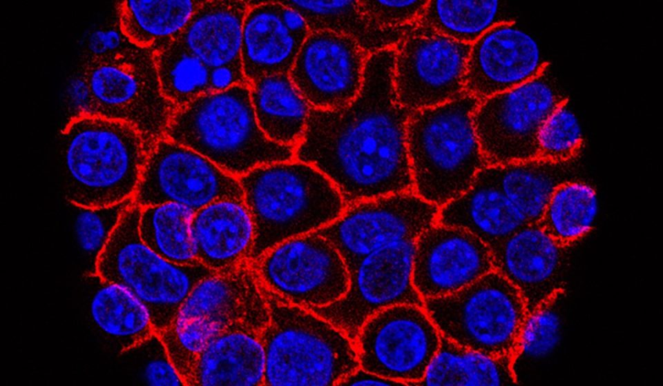 How a promising pancreatic cancer drug is losing its effectiveness