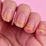 GLP-1 users report more nail detachment