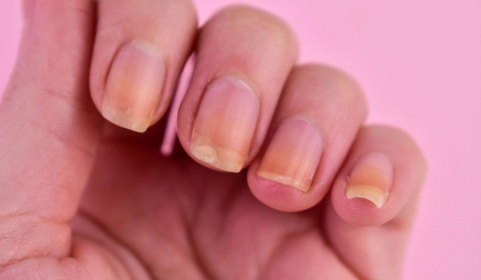 GLP-1 users report more nail detachment