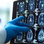 CDC: Deadly brain fungus among healthy Americans is on the rise