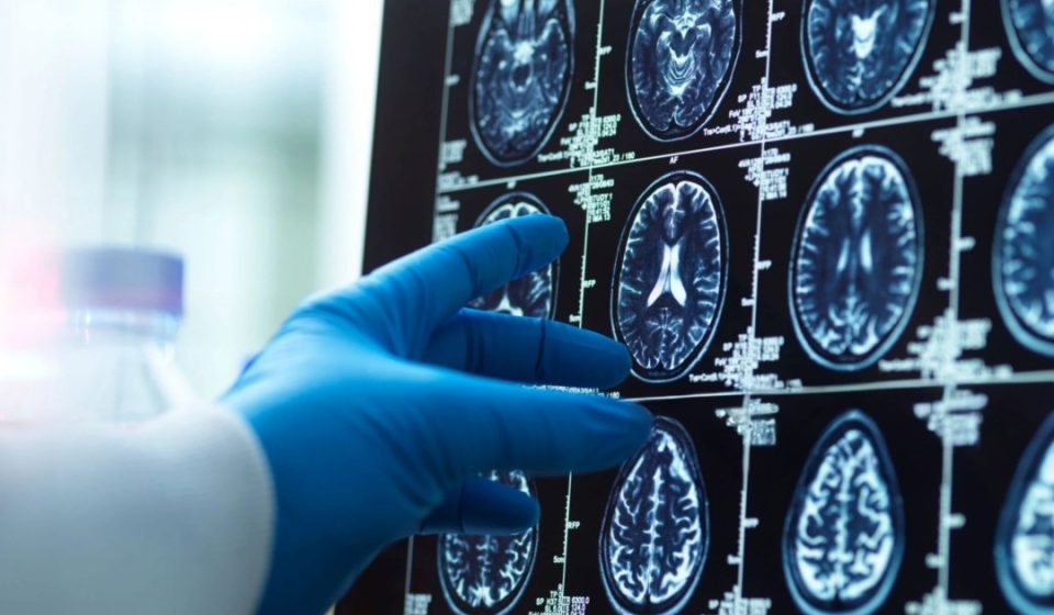 CDC: Deadly brain fungus among healthy Americans is on the rise