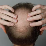About half of men are bald by age 50 – an evolutionary biologist explains why