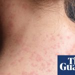 Pennsylvania faces largest measles outbreak in decades as cases rise to 1,000 | Pennsylvania