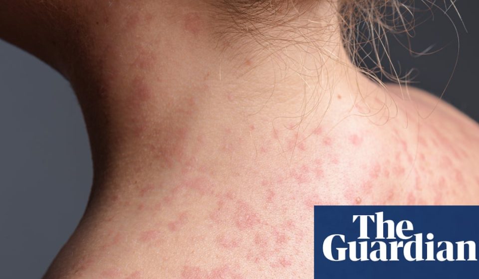 Pennsylvania faces largest measles outbreak in decades as cases rise to 1,000 | Pennsylvania
