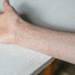 Oxford area high school closed Friday after confirmed measles case
