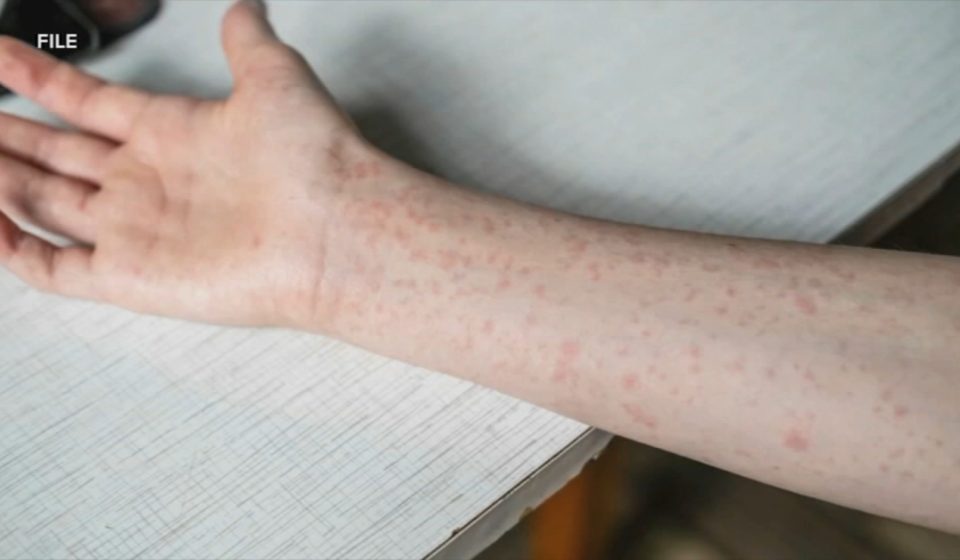 Oxford area high school closed Friday after confirmed measles case