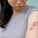 Shingles cases in young adults fall as first group vaccinated against chickenpox ages