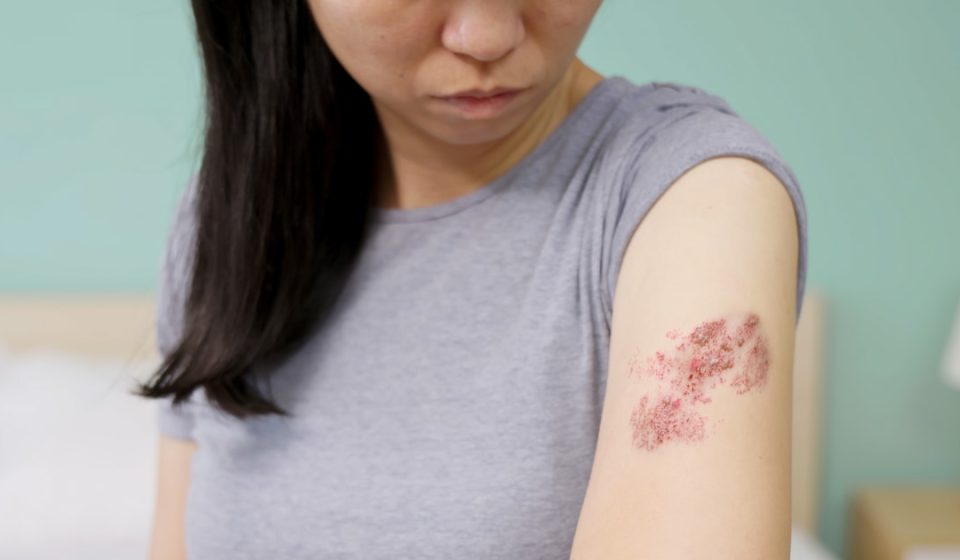 Shingles cases in young adults fall as first group vaccinated against chickenpox ages