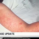 195 contacts identified in confirmed measles case in Huntsville