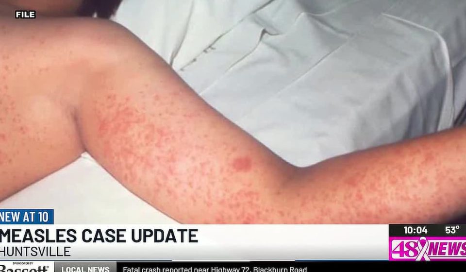 195 contacts identified in confirmed measles case in Huntsville