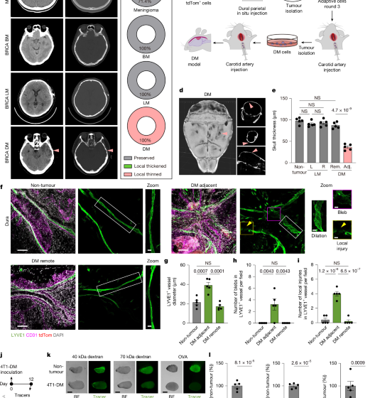 Osteoclasts intercept meningeal lymphatic pathways for dural metastases