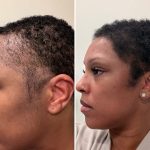I flew from the US to Turkey for a hair transplant before my wedding