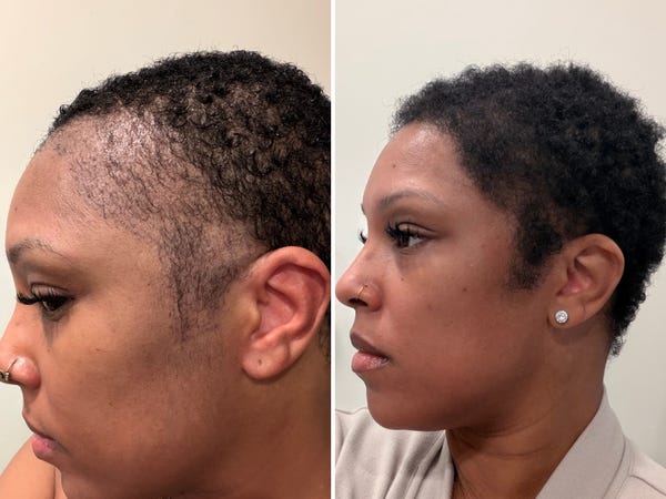I flew from the US to Turkey for a hair transplant before my wedding