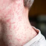 Pennsylvania reports fifth measles-associated death amid outbreak