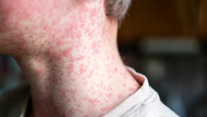 Pennsylvania reports fifth measles-associated death amid outbreak