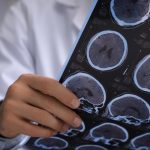 A brain-infecting fungus capable of killing 7 out of 10 patients is on the rise in the United States.