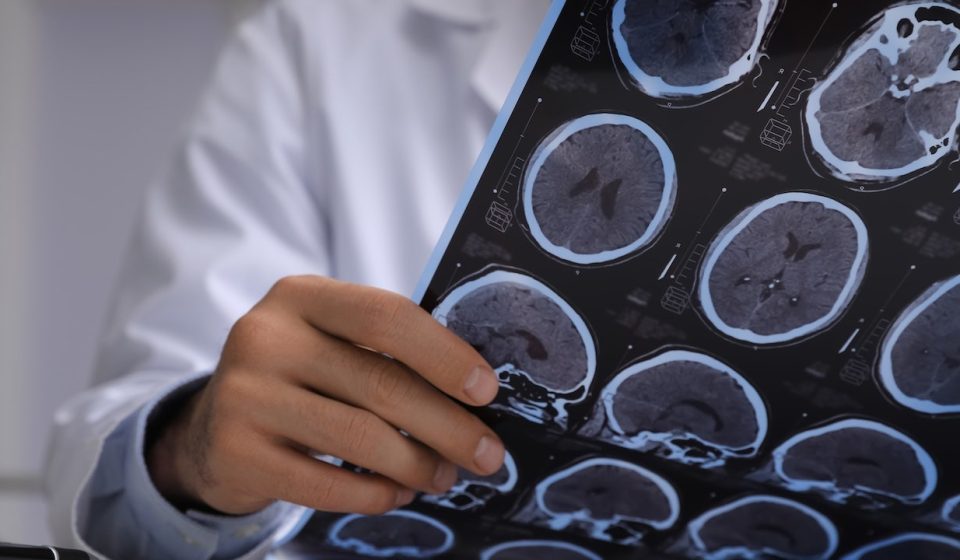 A brain-infecting fungus capable of killing 7 out of 10 patients is on the rise in the United States. A brain-infecting fungus capable of killing 7 out of 10 patients is on the rise in the United States.