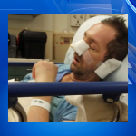 Former motocross racer explains how opioid addiction led to fentanyl use, sepsis and loss of his nose