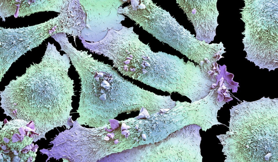 Beyond cigarettes: discovering the causes of lung cancer in non-smokers - The Washington Post
