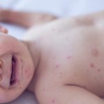 Pennsylvania issues congenital measles alert – something the US hasn't seen in decades