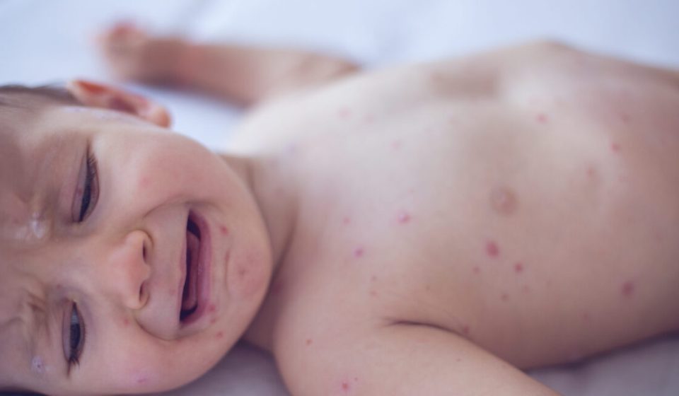 Pennsylvania issues congenital measles alert – something the US hasn't seen in decades