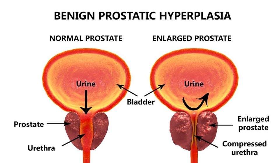 Scientists may have discovered why men’s prostates enlarge with age: ScienceAlert Scientists may have discovered why men's prostates enlarge with age: ScienceAlert