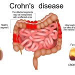 Why does IBD continue to get worse? Scientists have found a clue in the intestinal lining: ScienceAlert