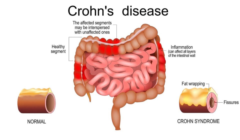 Why does IBD continue to get worse? Scientists have found a clue in the intestinal lining: ScienceAlert