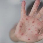 Measles exposure reported in Lebanon County, Pennsylvania Target – NBC10 Philadelphia