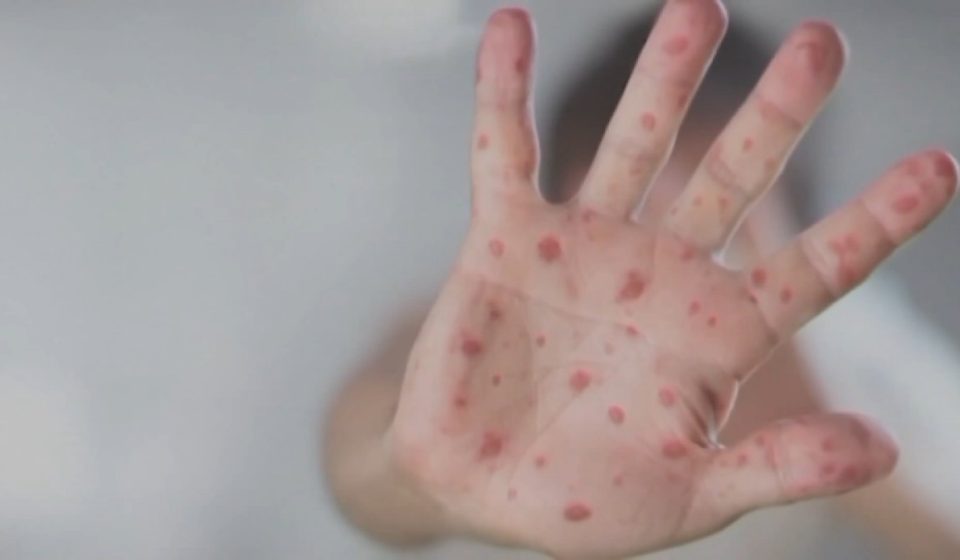 Measles exposure reported in Lebanon County, Pennsylvania Target – NBC10 Philadelphia